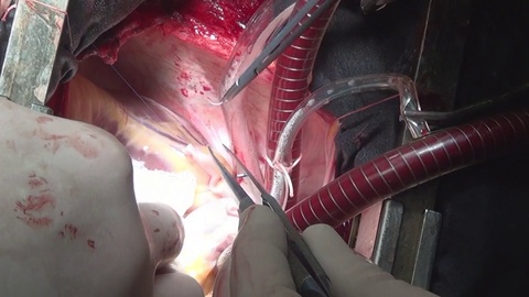 外科医生在临床活体器官做手术视频素材模板下载